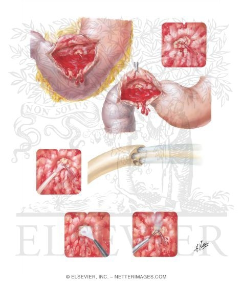 Watermarked preview of unlabeled image: Bleeding Lesions of Stomach and Duodenum