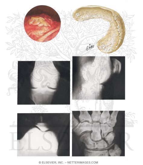 Watermarked preview of unlabeled image: Articular Chondrocalcinosis (Pseudogout)