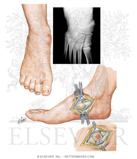 Accessory Navicular