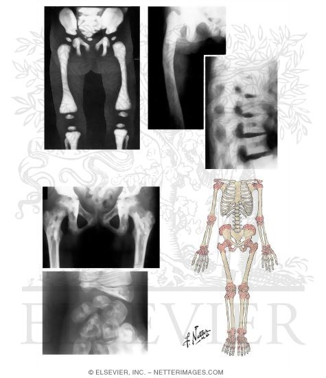 Osteopetrosis (Albers - Schonberg's Disease), Osteopoikilosis