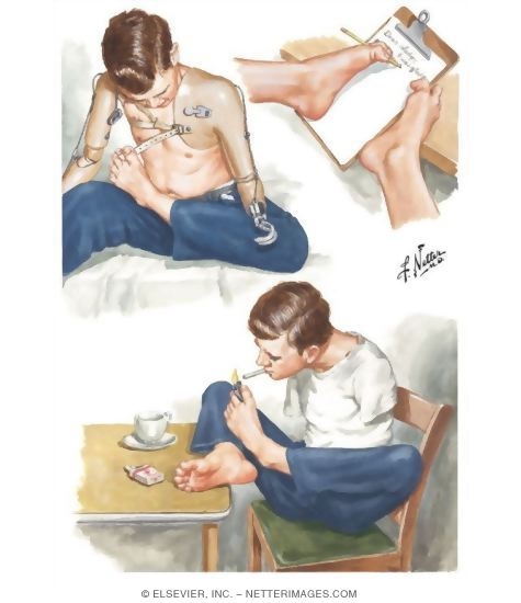 Congenital Limb Malformation