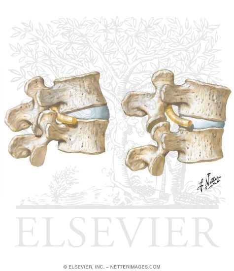 Watermarked preview of unlabeled image: Effects of Lumbar Hyperlordosis and Flexion on Spinal Nerve Roots