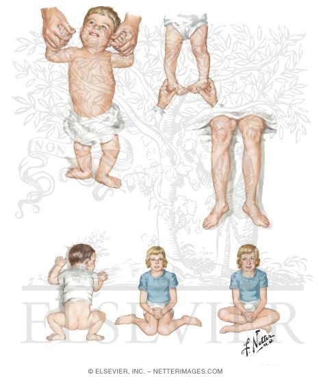 Watermarked preview of unlabeled image: Rotational Deformities of Lower Limb: Toeing Out