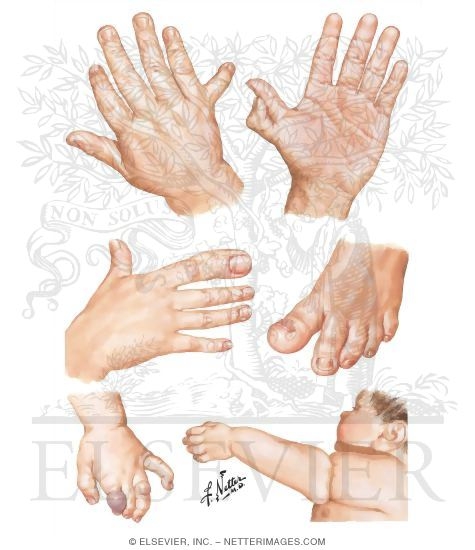 Duplication of Parts (polydactyly), Overgrowth (macrodactyly), and Congenital Constriction Band Syndrome