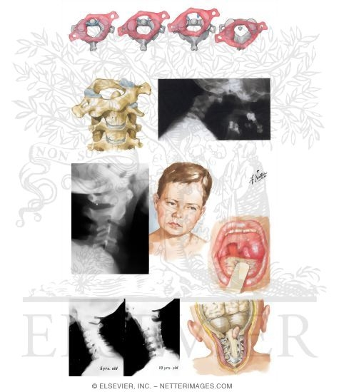 Watermarked preview of unlabeled image: Nonmuscular Causes of Torticollis