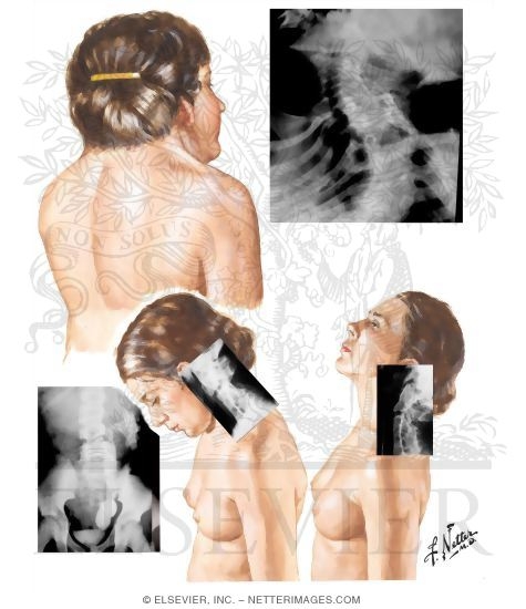 Synostosis of Cervical Spine (Klippel-Feil Syndrome)