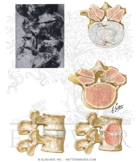Pathology of Spinal Stenosis