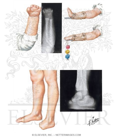 Failure of Formation of Parts: Transverse Arrest (Transmetacarpal amputation type aphalangia) (Transtarsal amputation type adactyly)