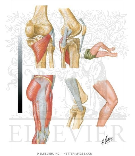 Watermarked preview of unlabeled image: Popliteus Tendinitis - lliotibial 