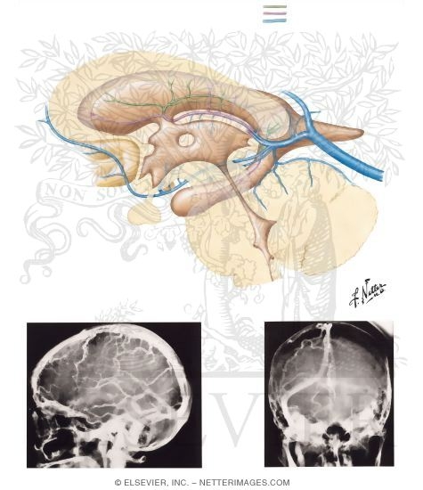 Watermarked preview of unlabeled image: Subependymal Veins of Brain