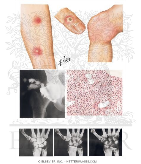 Watermarked preview of unlabeled image: Infectious Arthritis