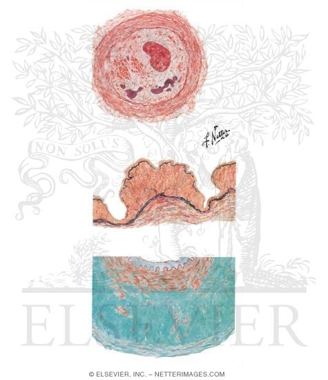 Watermarked preview of unlabeled image: Renal Artery Disease Causing Hypertension