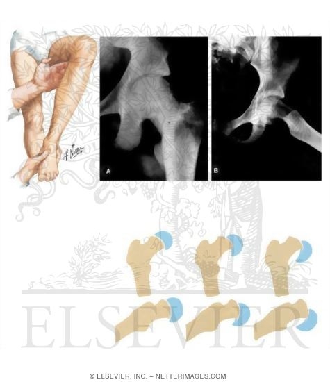 Slipped Capital Femoral Epiphysis