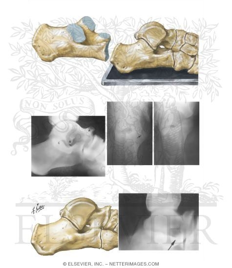 Watermarked preview of unlabeled image: Tarsal Coalition
