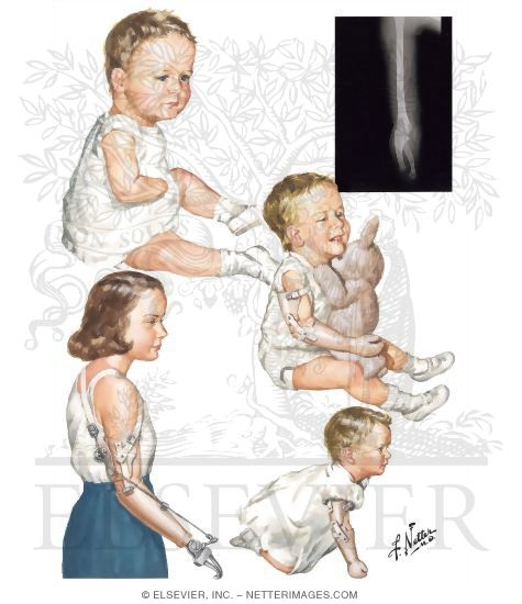 Watermarked preview of unlabeled image: Failure of Formation of Parts: Transverse Arrest (Forearm amputation type partial hemimelia)