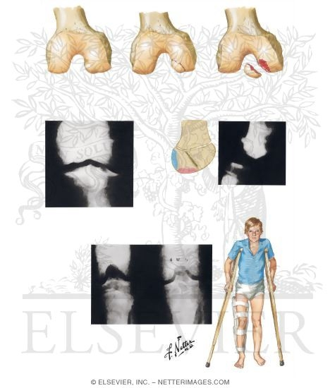 Watermarked preview of unlabeled image: Osteochondritis Dissecans