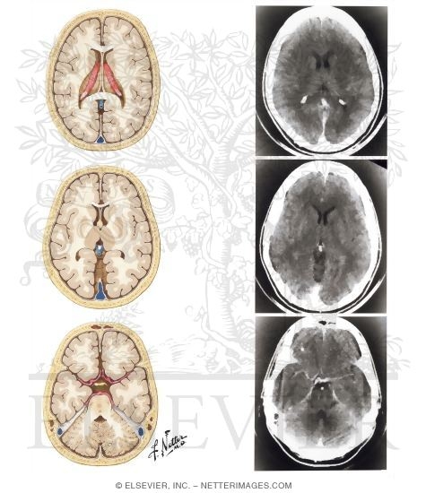 Normal Brain Anatomy as Demonstrated by Computerized Tomography (CT Scanning)