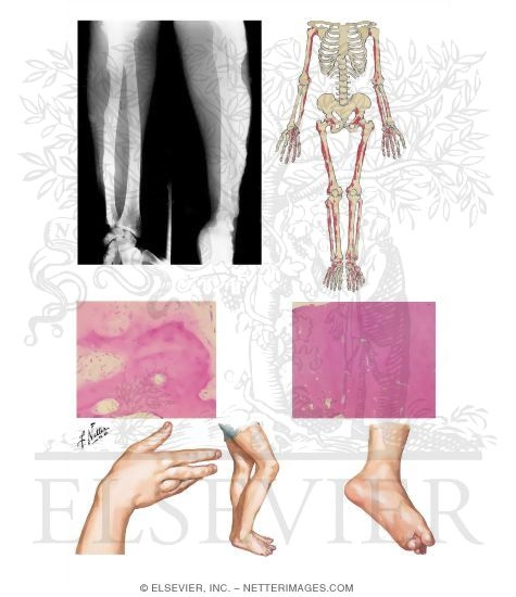 Watermarked preview of unlabeled image: Melorheostosis