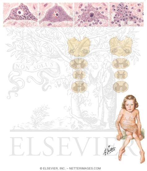 Watermarked preview of unlabeled image: Poliomyelitis