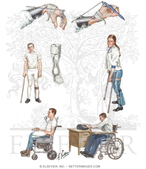 Cervical Spine Injury: Rehabilitation of Patient