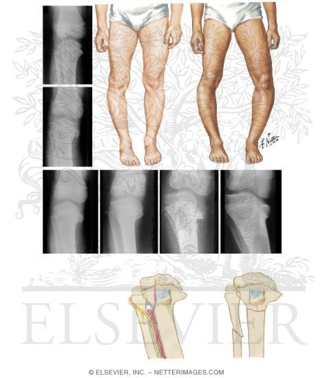Blount's Disease
Infantile Tibia Vara