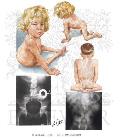 Watermarked preview of unlabeled image: Lumbosacral Agenesis