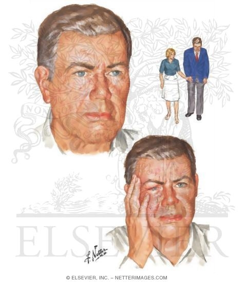 Cluster Headache 