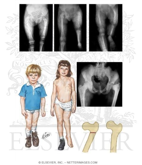 Congenital Short Femur with Coxa Vara