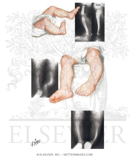 Watermarked preview of unlabeled image: Congenital Bowing of Tibia