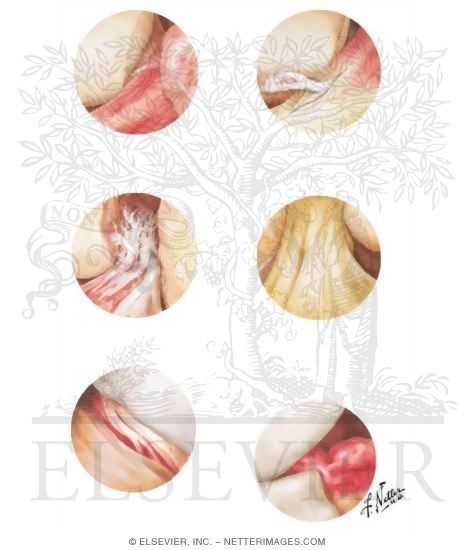 Extrasynovial (Ligamentous) Pathology