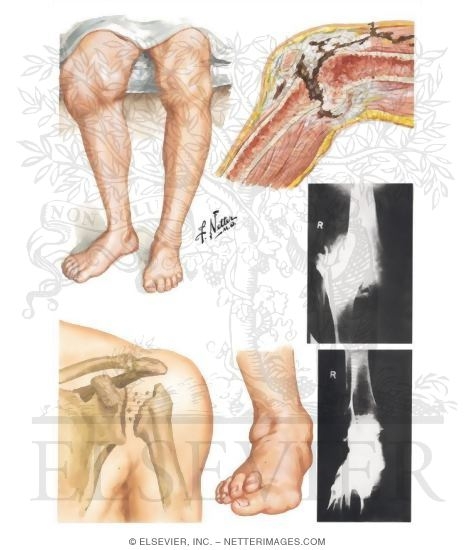 Watermarked preview of unlabeled image: Neuropathic Joint Disease