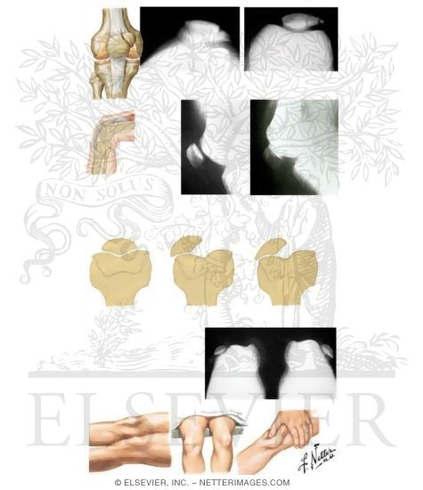 Watermarked preview of unlabeled image: Disorders of Patella