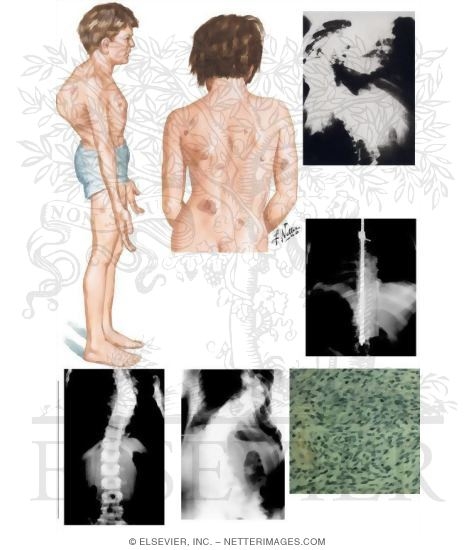 Watermarked preview of unlabeled image: Spinal Deformities in Neurofibromatosis