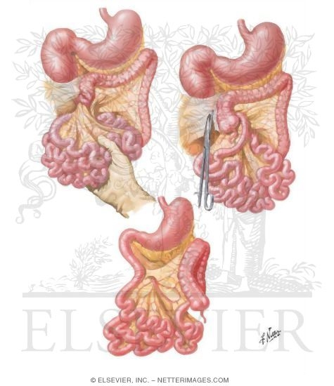Malrotation of Colon and Volvulus of Midgut