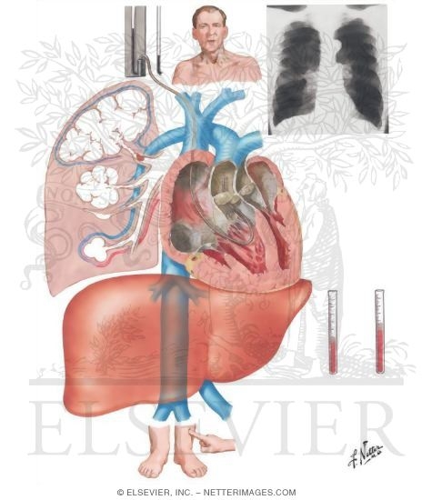 Cor Pulmonale