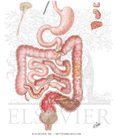 Watermarked preview of unlabeled image: Diarrhea