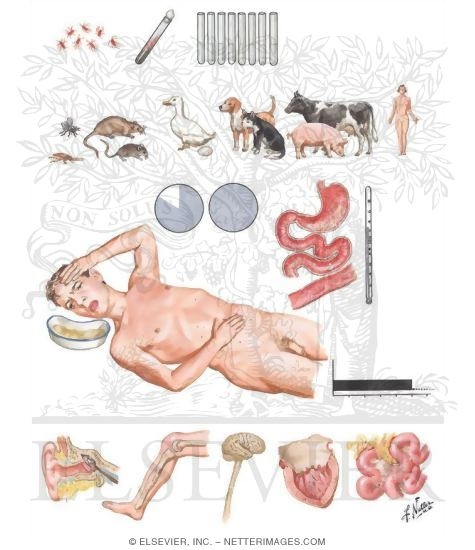 Watermarked preview of unlabeled image: Infection Type of Food Poisoning 