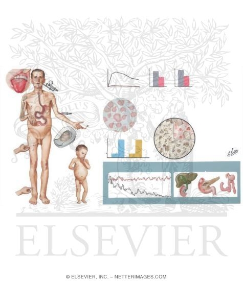 Enterogenous Malabsorption Syndrome (Sprue Syndrome)