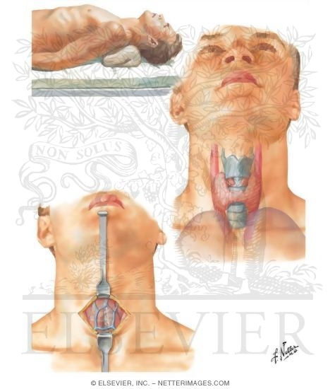 Watermarked preview of unlabeled image: Tracheotomy