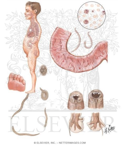 Watermarked preview of unlabeled image: Parasitic Diseases V - Necatoriasis and Ancylostomiasis