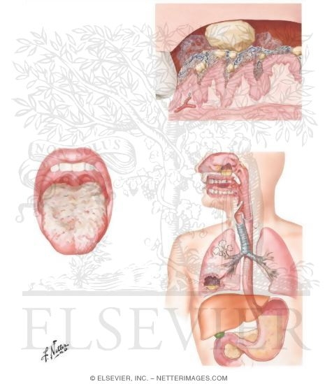 Watermarked preview of unlabeled image: Coated Tongue and Halitosis