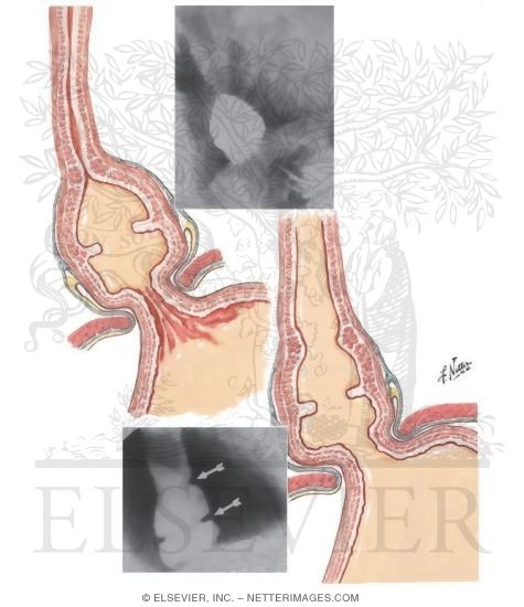 Watermarked preview of unlabeled image: Inferior Esophageal Ring Formation