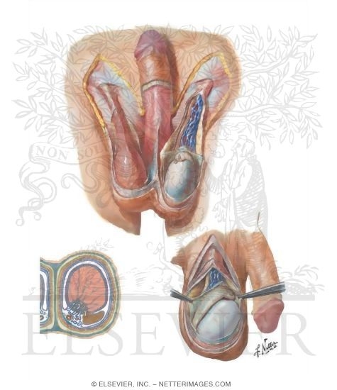 Illustration of Covering Structures of the Testicles
Scrotum and Contents
Testis, Epididymis and Ductus Deferens from the Netter Collection