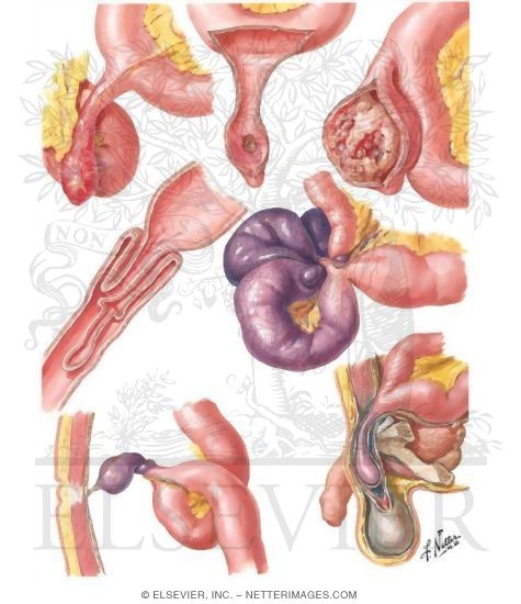 Meckel Diverticulum - Vitelline Duct Remnants
