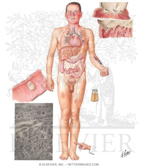 Watermarked preview of unlabeled image: Carcinoid Syndrome