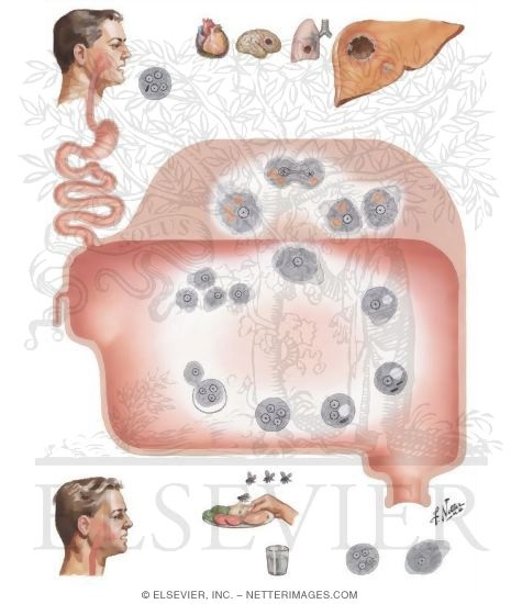 Amebiasis