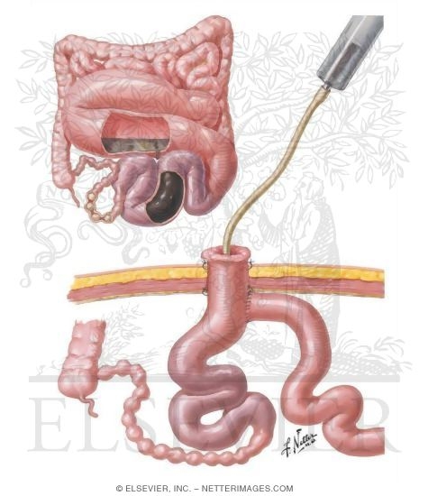 Meconium Ileus