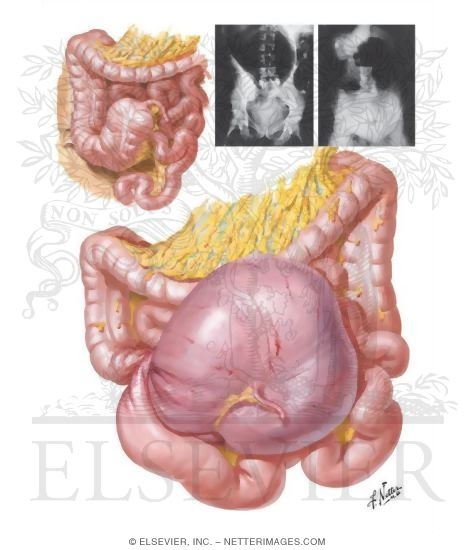 Volvulus of the Cecum