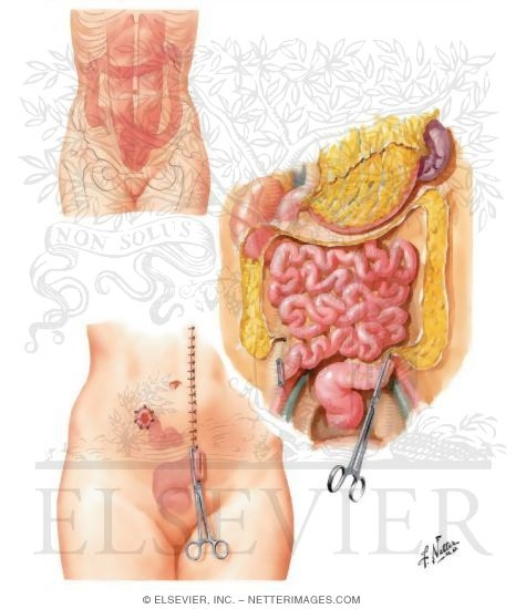 Ileostomy and Subtotal Colectomy