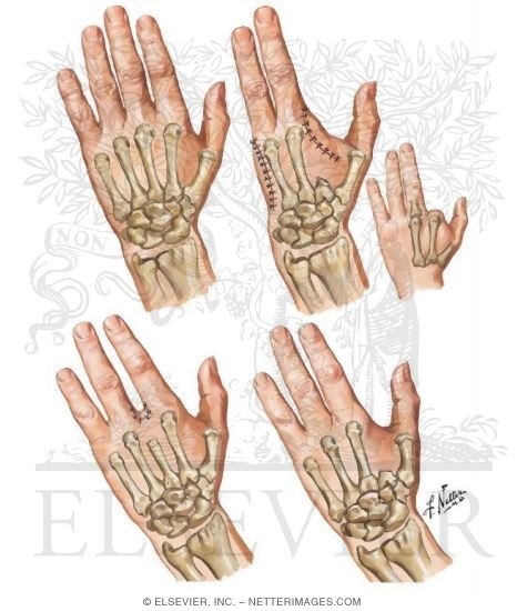 Removal of An Entire Finger Or Fingers